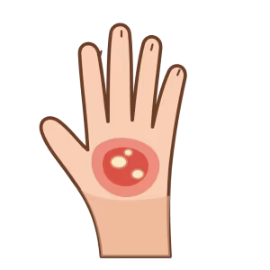 Ilustración de mano con quemadura térmica