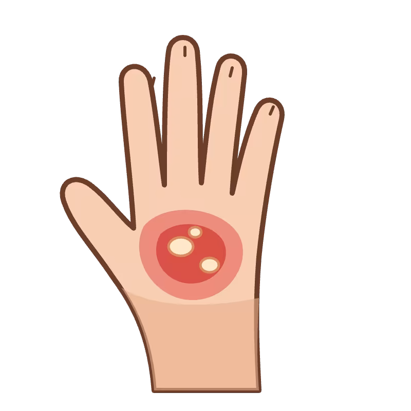 Ilustración de mano con quemadura térmica