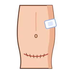 Ilustración de abdomen con herida quirúrgica en recuperación
